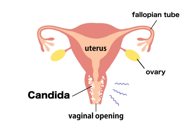 bildbanksillustrationer, clip art samt tecknat material och ikoner med vaginitis clip art of diseased uterus - klamydiatest