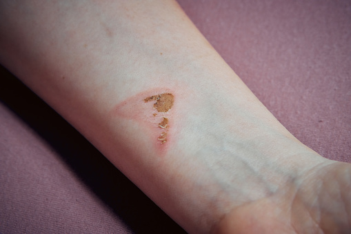severe burn on a woman's hand.