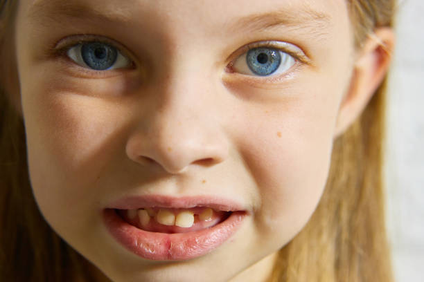 malocclusion of large front teeth in young children.
