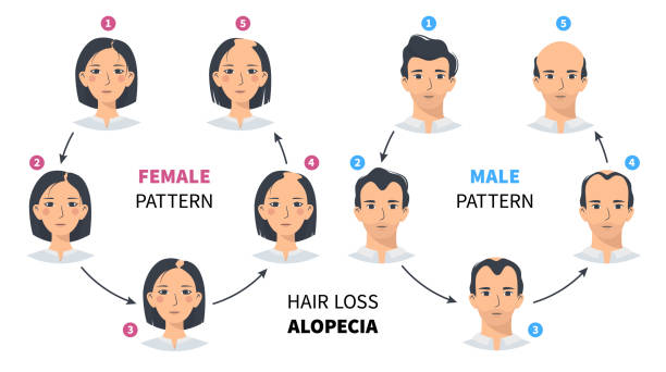 ilustrações, clipart, desenhos animados e ícones de estágios de queda de cabelo, infográfico do círculo de alopecia masculino e feminino - alopecia antes depois