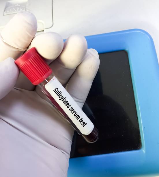 scientist hold blood sample for salicylates serum test in laboratory. diagnosis salicylate intoxication - intoxication imagens e fotografias de stock