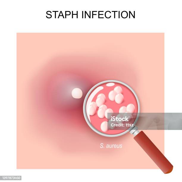 Stack Infection Staph Infection Acne Stock Illustration - Download Image Now ...