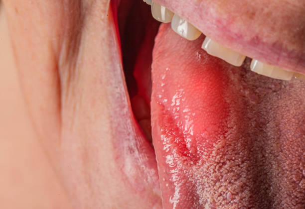 Inflammatory disease in the tongue. Red spot, glossitis. Hygiene of the tongue, close-up. Symptom of vitamin deficiency and bacteria Inflammatory disease in the tongue. Red spot, glossitis. Hygiene of the tongue male yeast infection symptoms stock pictures, royalty-free photos & images