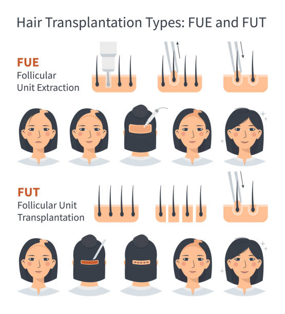 Female hair transplantation FUE and FUT infographic Female hair transplantation FUE and FUT, stages of Follicular Unit Extraction. Treatment of baldness, alopecia and hair loss. Vector medical infographic, woman's head scalp. Strip and graft machine. follicular thyroid cancer stock illustrations