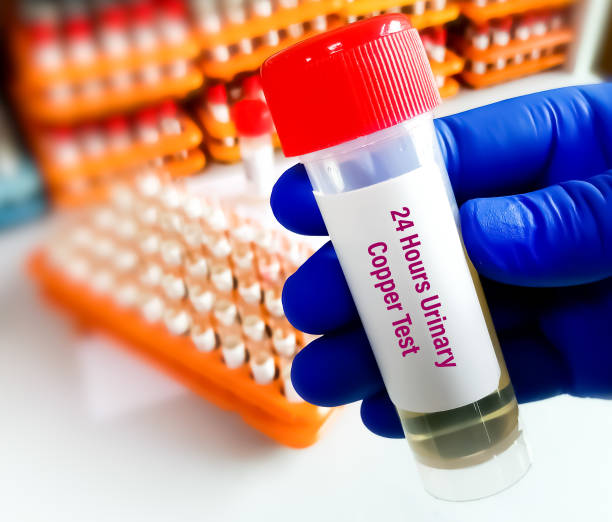Urine sample for 24 hours urinary copper test to diagnose copper toxicity. stock photo