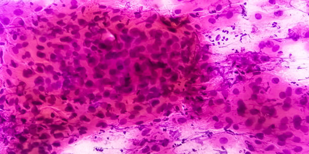 istock Pap's smear: pap stain Microscopic view show High-grade squamous intraepithelial lesion is a pre-cancerous, sexually transmitted disease 1397932279