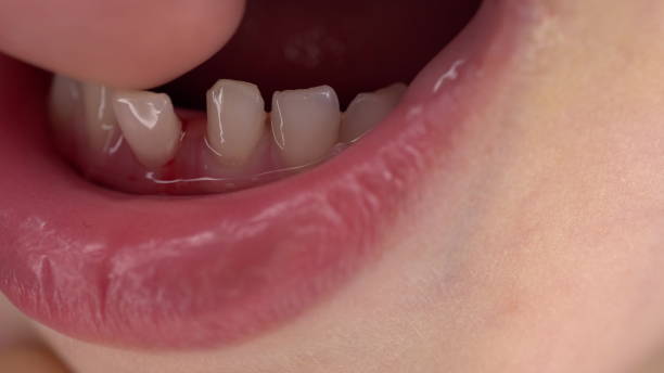 istock A small child has a loose milk tooth. Shaking tooth close-up. 1397966842