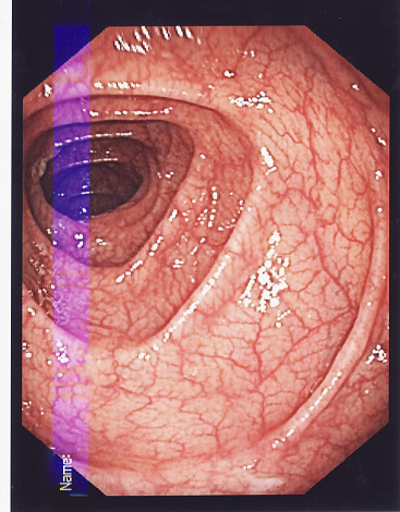 Colonoscopy showing a clean and healthy intestine