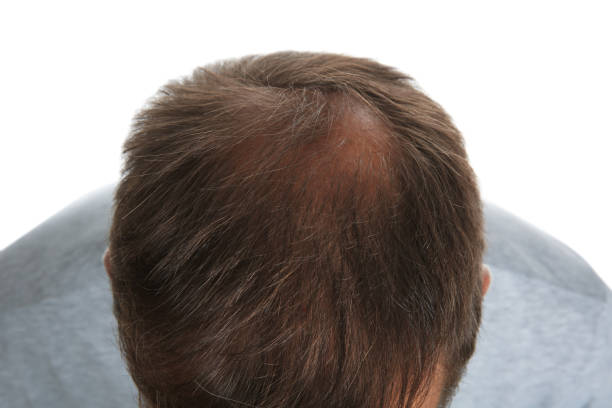 istock Man with hair loss problem isolated on white, above view 1398080703