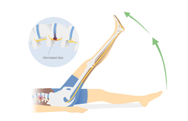 illustrazioni stock, clip art, cartoni animati e icone di tendenza di le persone che fanno sciatica si allungano per alleviare il dolore dall'ernia del disco. diagramma di esercizi per il trattamento del mal di schiena con sollevamento delle gambe. fisioterapia. - backache pain physical injury sport