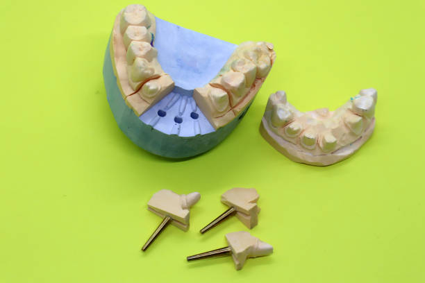 istock Plaster casts of teeth. Preparation for prosthetics. Installation of implants. 1398087461