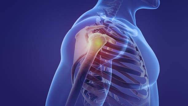 istock Animation of a painful shoulder 1398089387
