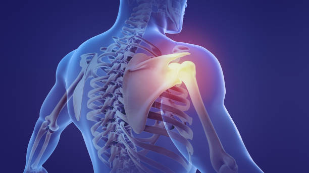 istock Animation of a painful shoulder 1398089389