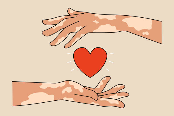 Person with leprosy hold heart Person hands suffering from leprosy disease holding heart show care and support. World leprosy day awareness, healthcare and medicine concept. Flat vector illustration. vitiligo stock illustrations