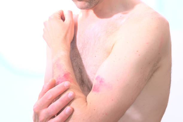 Caucasic man feeling elbow with visible skin eruption due to monkey pox. High quality photo