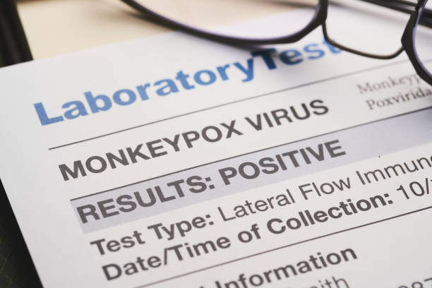 Monkeypox virus test results document stock photo