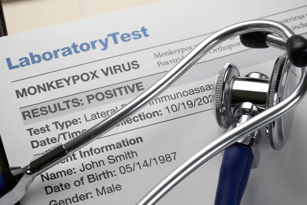 Monkeypox virus test results document with stethoscope stock photo