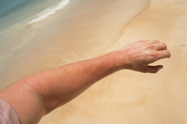 istock Sunburnt hand of unrecognizable man on the beach 1398278102