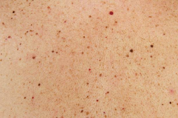 Moles and birthmark on human skin stock photo