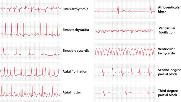 schemasatz von häufigen elektrokardiogramm (ekg) anomalien - pulslinie stock-grafiken, -clipart, -cartoons und -symbole