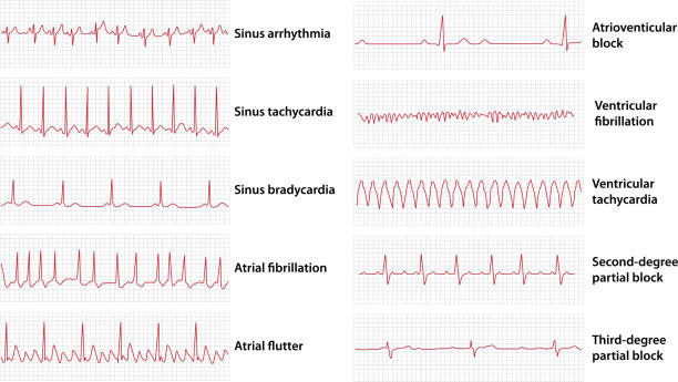 Scheme set of common electrocardiogram (ECG) abnormalities Scheme set of common electrocardiogram (ECG) abnormalities, including partial blocks and flutter heart rate stock illustrations