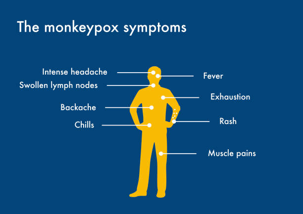 The monkeypox symptoms The main signs and symptoms of monkeypox viral disease mpox stock illustrations