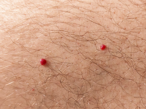 Close up photo of cherry angioma on human hairy skin