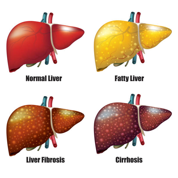 Stages of Liver Disease Liver diseases cirrhosis stock illustrations