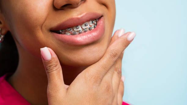 Orthodontic treatment. Teeth with braces stock photo