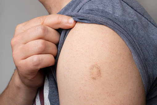Cicatriz de la vacuna contra la viruela y la viruela en el brazo de un joven photo