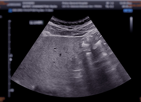 Ultrasound upper abdomen showing  liver.