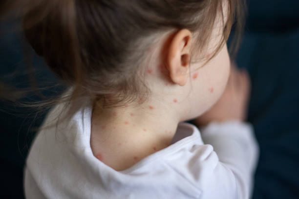 Girl with chickenpox measles on the body Close-up of a girl with chickenpox measles on the body pox stock pictures, royalty-free photos & images