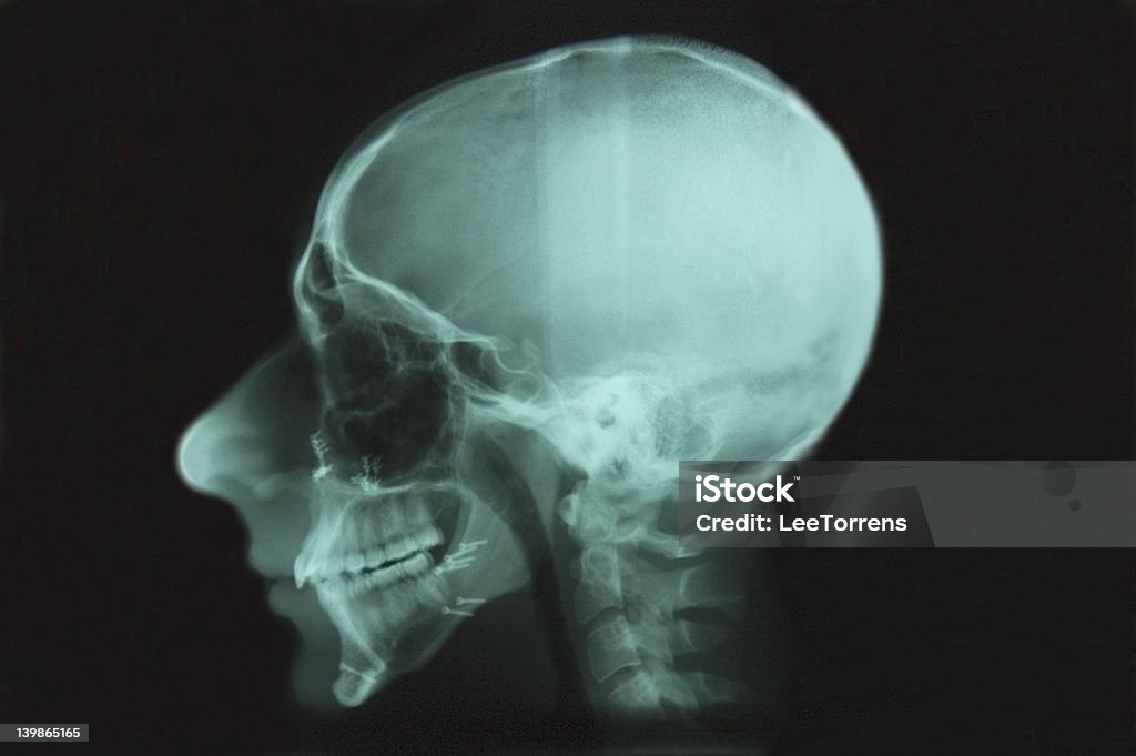 Head X-ray mit Schrauben IV - Lizenzfrei Anatomie Stock-Foto