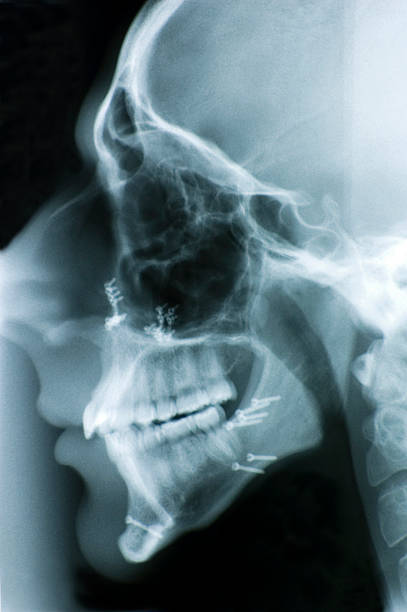 Head X-ray with Screws stock photo