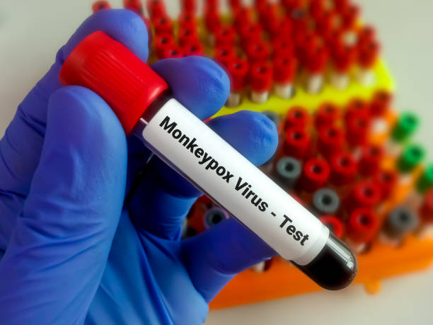 Blood sample for Monkeypox virus test. It is also known as the Moneypox virus, a double-stranded DNA virus and member of Poxviridae family. stock photo