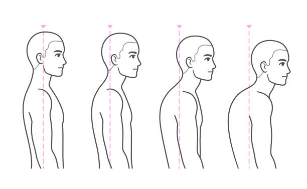 Spine kyphosis progression stages Spine kyphosis progression stages. Young man with rounded back and shoulders, forward head syndrome. Back posture problems medical diagram, vector illustration. human back stock illustrations