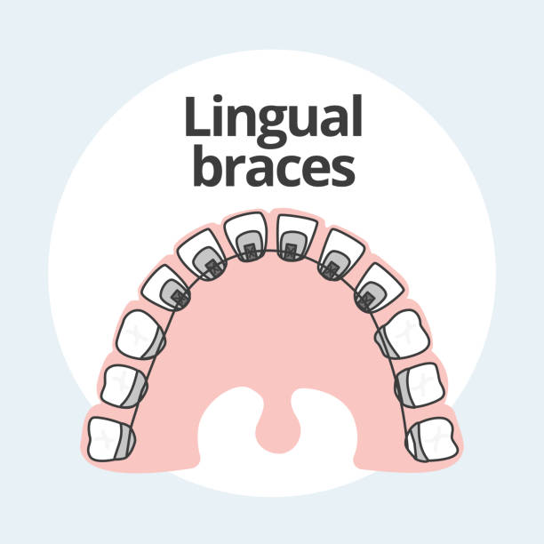 ilustraciones, imágenes clip art, dibujos animados e iconos de stock de brackets linguales ortodoncista ilustrador vectorial - lingual