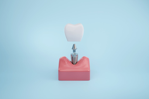 Dental teeth implant insert to healthy gum on blue background. 3D rendering.