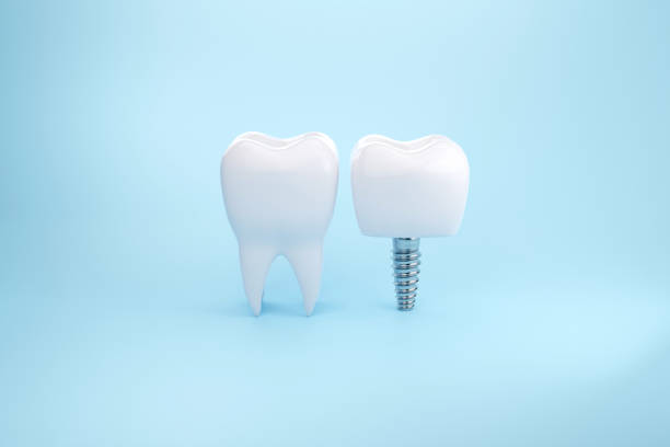 istock Clean Healthy tooth and Implant 1398742727