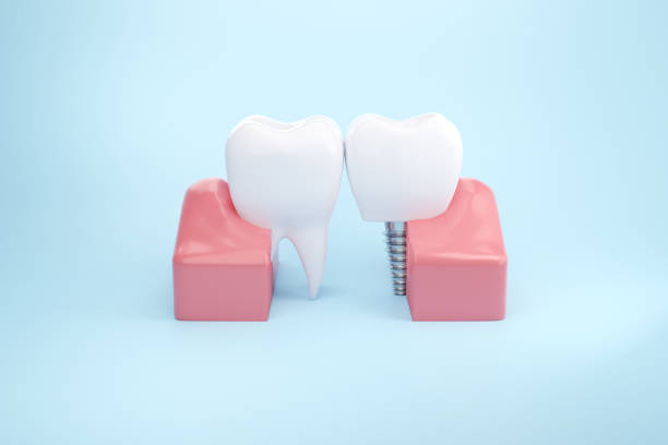 istock Clean Tooth dental implant with gums 1398742738