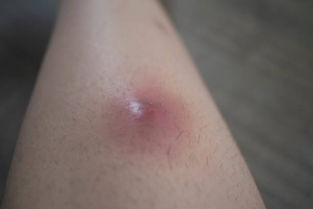 Close up of an abscess on a leg caused intially by a razor blade cut that became infected. Close up of an abscess on a leg caused intially by a razor blade cut that became infected. abscess stock pictures, royalty-free photos & images