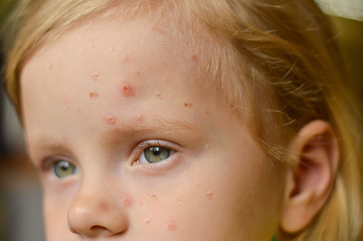 Primer plano de una niña caucásica con granos y úlceras en la cara. Nueva enfermedad de la viruela del mono peligrosa en todo el mundo. photo