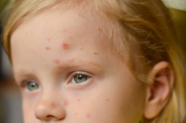 Close-up of a Caucasian girl with pimples and ulcers on her face. Monkeypox new disease dangerous over the world. Monkeypox new disease dangerous over the world. Selective focus. Close-up of a Caucasian girl with pimples and ulcers on her face. mpox stock pictures, royalty-free photos & images