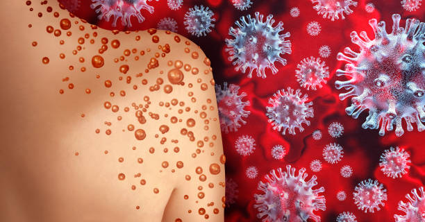 Monkeypox Outbreak Monkeypox Virus Outbreak as a contagious infection as blisters and leisons on the skin representing transmission of an infected person with 3D illustration elements. mpox stock pictures, royalty-free photos & images