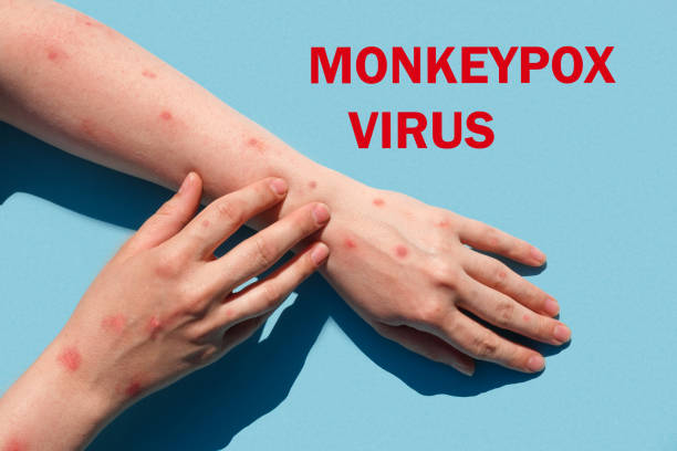 istock Phrase MONKEYPOX VIRUS on blue background and Patient with Monkey Pox. Monkeypox new disease dangerous over the world. Painful rash, red spots blisters. Close up human hands with Health problem. 1398842862