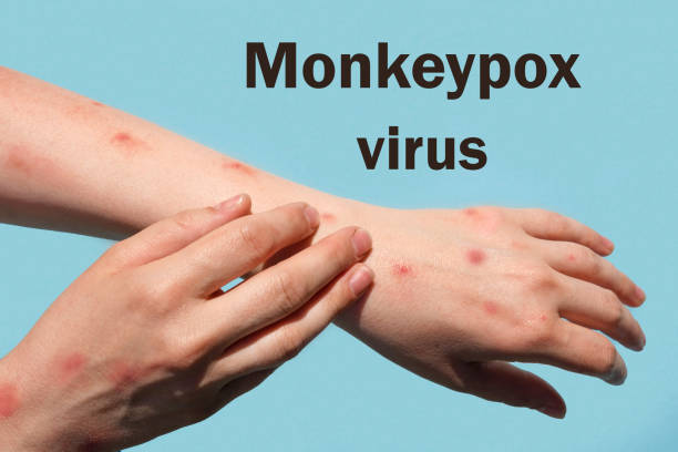 istock Phrase MONKEYPOX VIRUS on blue background and Patient with Monkey Pox. Monkeypox new disease dangerous over the world. Painful rash, red spots blisters. Close up human hands with Health problem. 1398845576