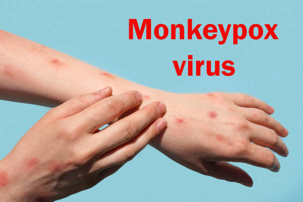 istock Phrase MONKEYPOX VIRUS on blue background and Patient with Monkey Pox. Monkeypox new disease dangerous over the world. Painful rash, red spots blisters. Close up human hands with Health problem. 1398845782
