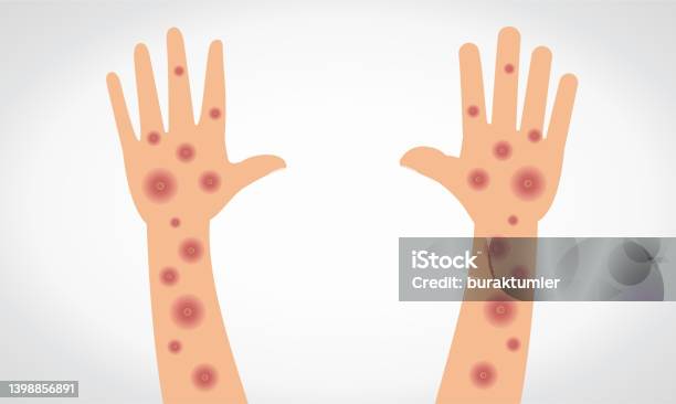 Monkeypox Virus Vectorial Monkeypox Virus On Hand And Arm向量圖形及更多猴痘圖片