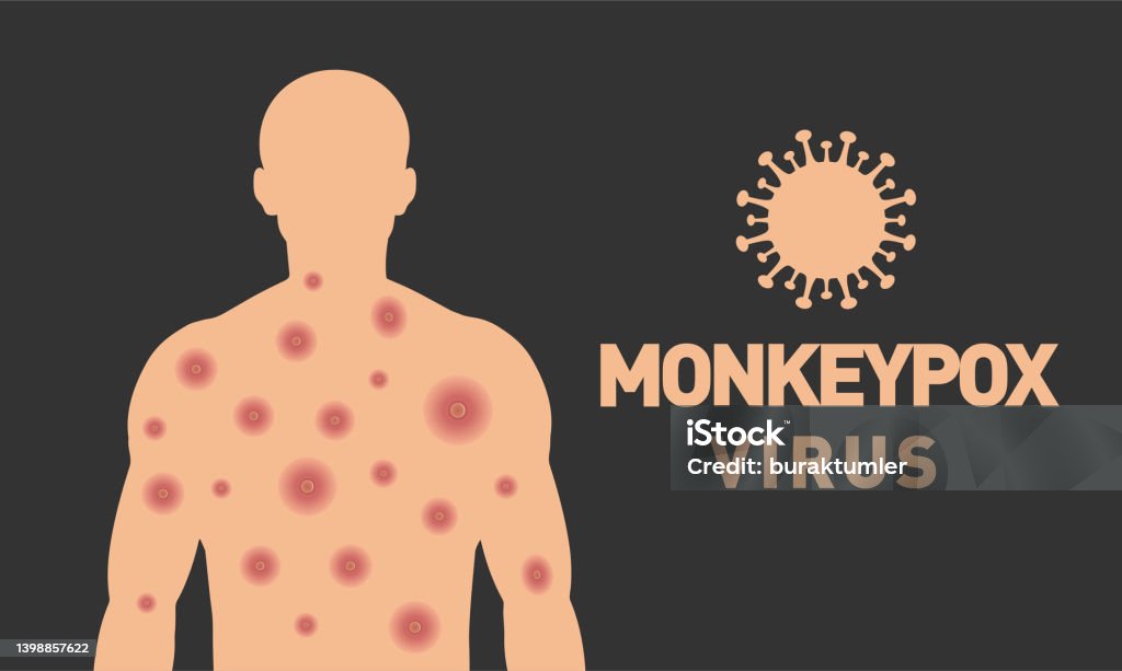 Monkeypox virus. Monkeypox virus banner design. Scars on the body. Vector design. - Royalty-free Varíola dos Macacos arte vetorial