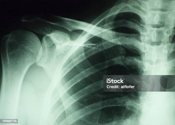 X Ray Części Ciała - zdjęcia stockowe i więcej obrazów Badanie lekarskie - Badanie lekarskie, Ból, Cukierek